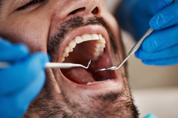 Best Broken or Cracked Tooth Emergency Dentist in Butler, NJ